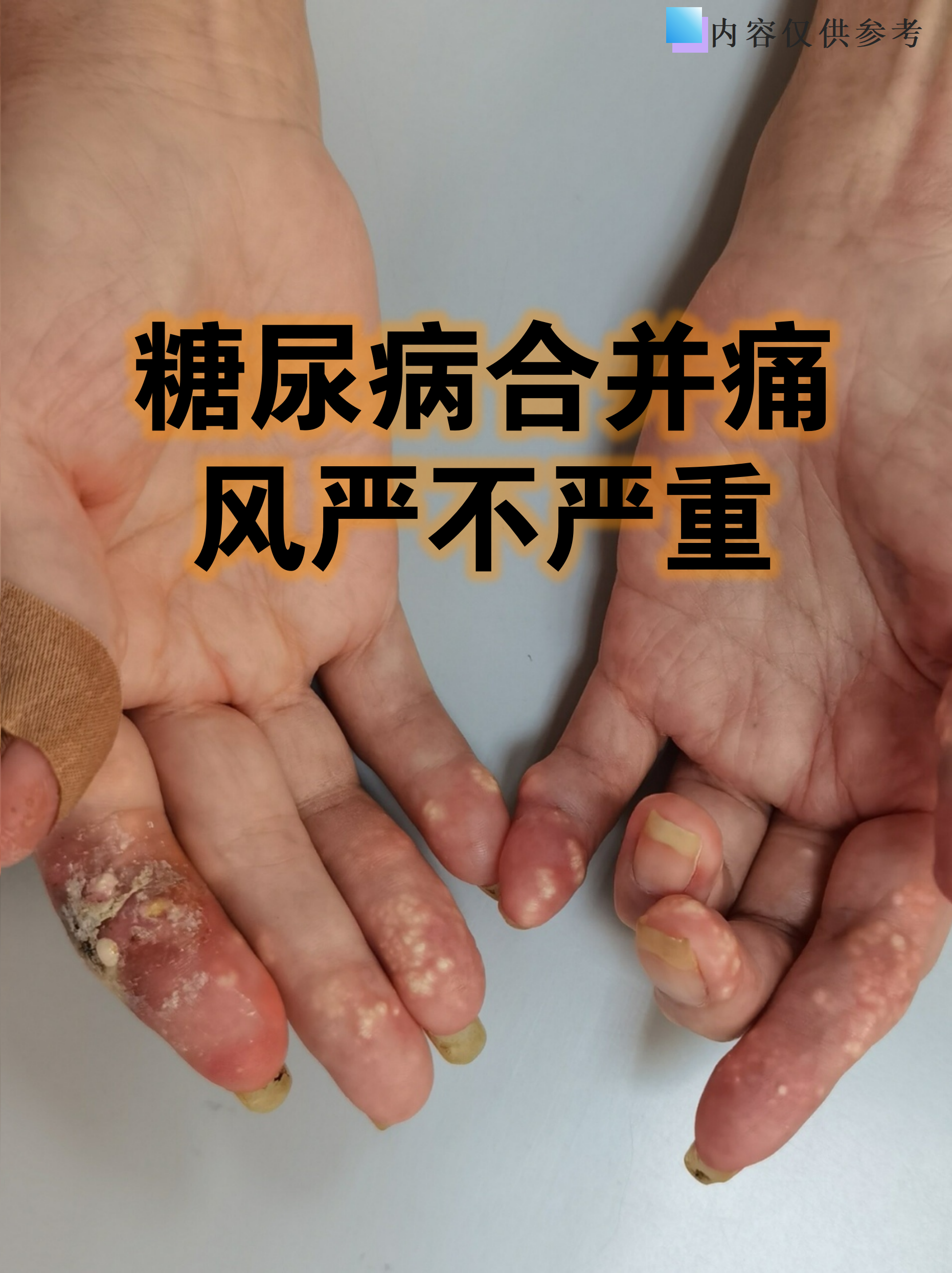 研究证实降尿酸治疗可延缓慢性肾脏病进展